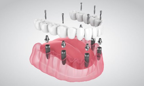 Full mouth Dental Implant in Nagpur