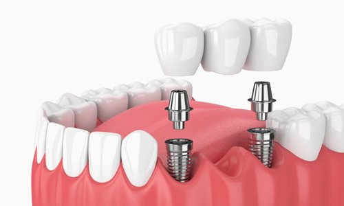 Implant-Supported Bridges in Nagpur