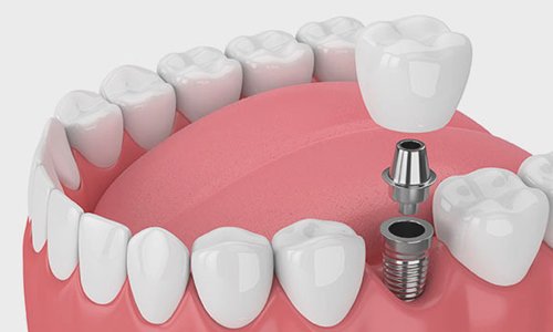 Single-Tooth Implants in Nagpur